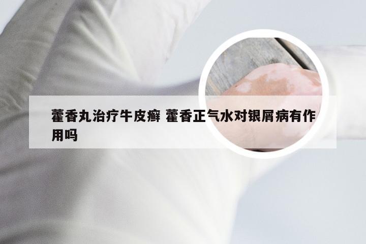 藿香丸治疗牛皮癣 藿香正气水对银屑病有作用吗