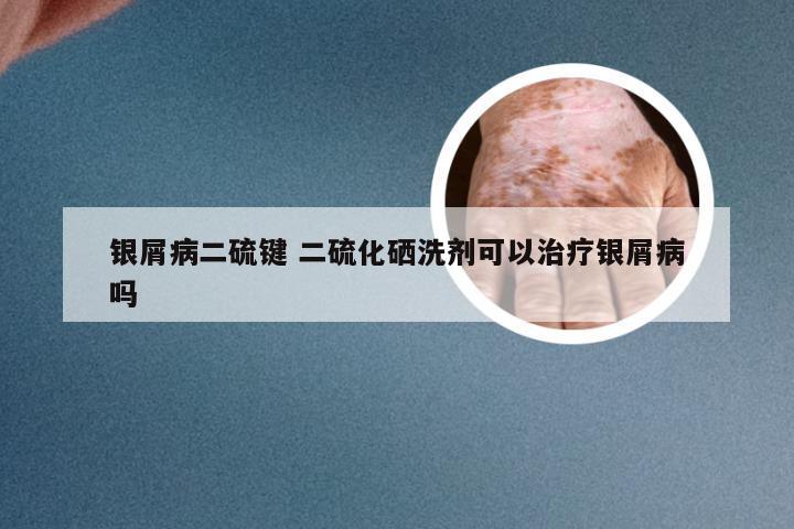 银屑病二硫键 二硫化硒洗剂可以治疗银屑病吗