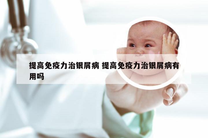 提高免疫力治银屑病 提高免疫力治银屑病有用吗