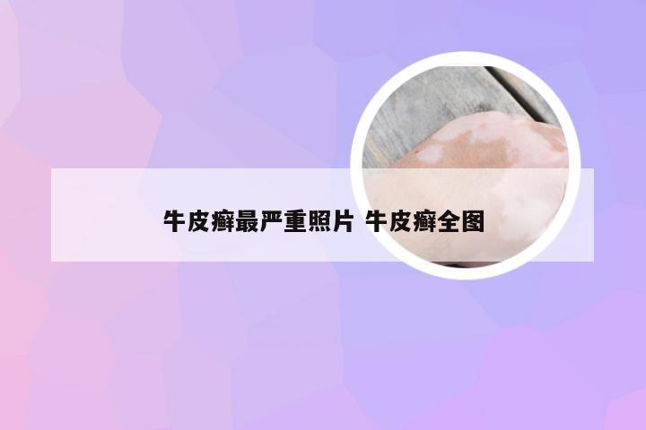 牛皮癣最严重照片 牛皮癣全图