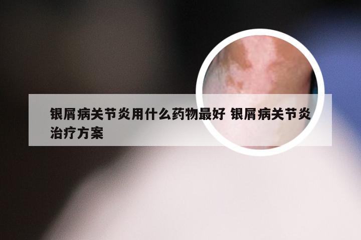 银屑病关节炎用什么药物最好 银屑病关节炎治疗方案