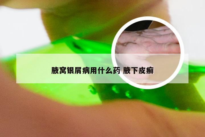 腋窝银屑病用什么药 腋下皮癣
