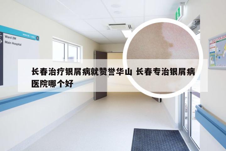 长春治疗银屑病就赞誉华山 长春专治银屑病医院哪个好
