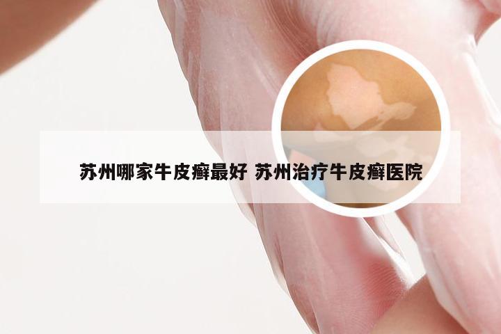 苏州哪家牛皮癣最好 苏州治疗牛皮癣医院