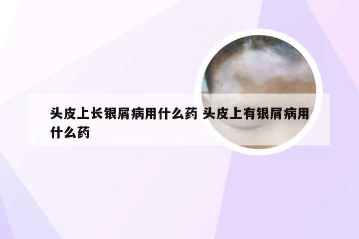 头皮上长银屑病用什么药 头皮上有银屑病用什么药