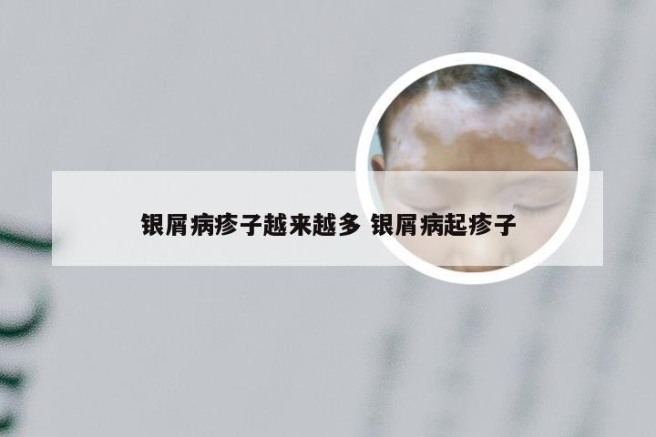 银屑病疹子越来越多 银屑病起疹子
