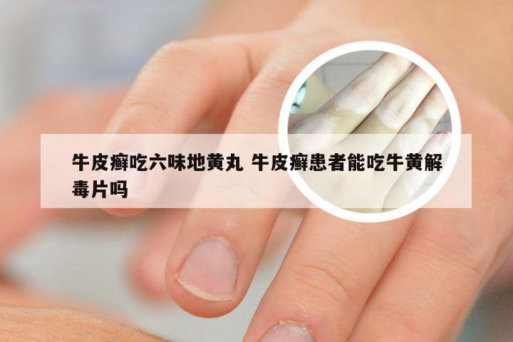 牛皮癣吃六味地黄丸 牛皮癣患者能吃牛黄解毒片吗