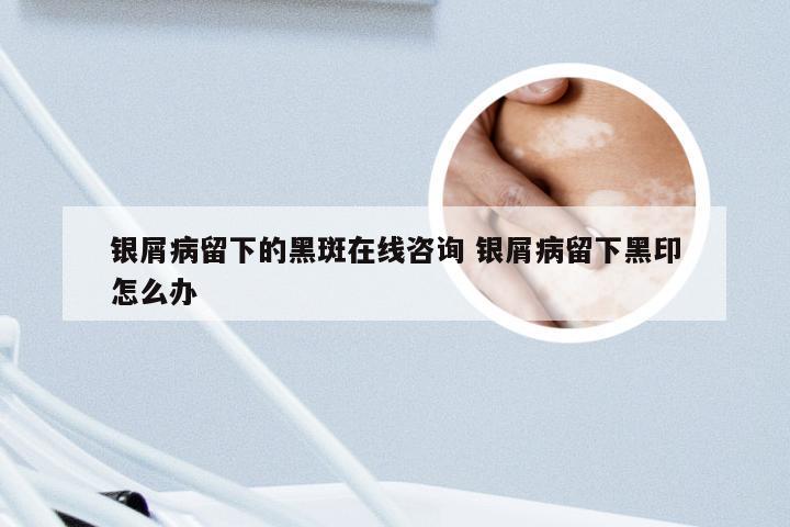 银屑病留下的黑斑在线咨询 银屑病留下黑印怎么办