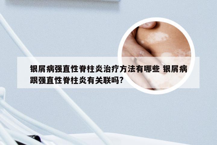 银屑病强直性脊柱炎治疗方法有哪些 银屑病跟强直性脊柱炎有关联吗?