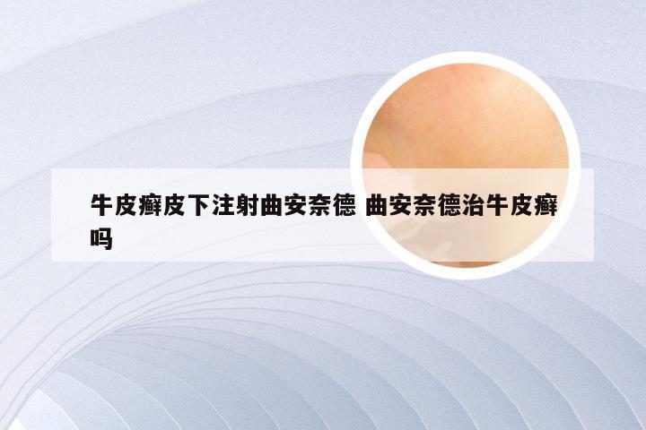 牛皮癣皮下注射曲安奈德 曲安奈德治牛皮癣吗