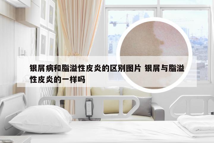 银屑病和脂溢性皮炎的区别图片 银屑与脂溢性皮炎的一样吗