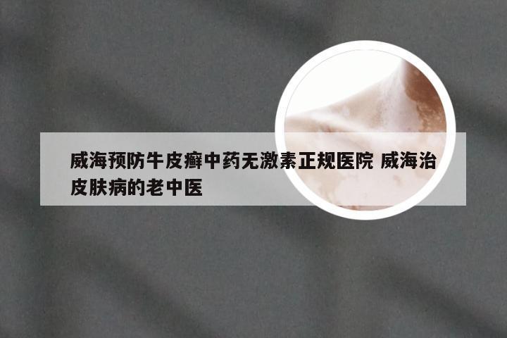 威海预防牛皮癣中药无激素正规医院 威海治皮肤病的老中医