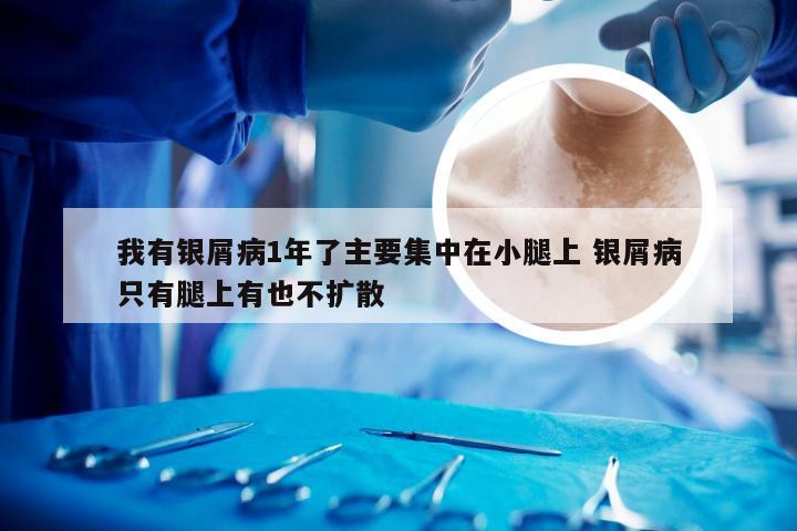我有银屑病1年了主要集中在小腿上 银屑病只有腿上有也不扩散
