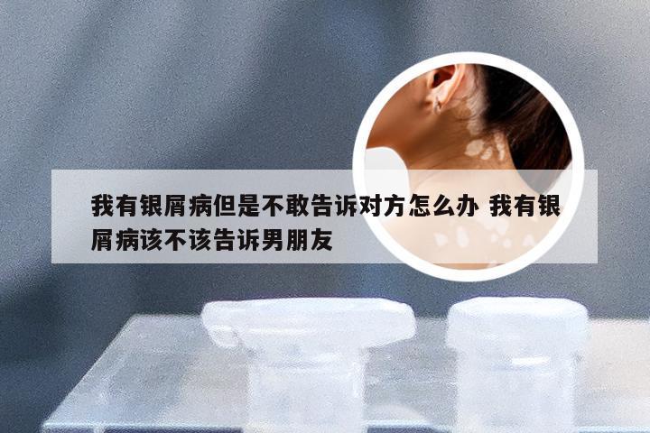 我有银屑病但是不敢告诉对方怎么办 我有银屑病该不该告诉男朋友