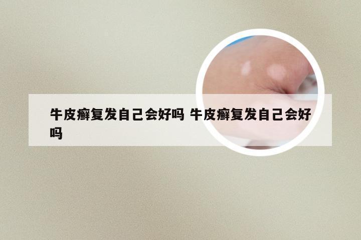 牛皮癣复发自己会好吗 牛皮癣复发自己会好吗