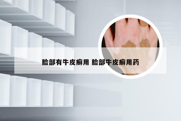 脸部有牛皮癣用 脸部牛皮癣用药