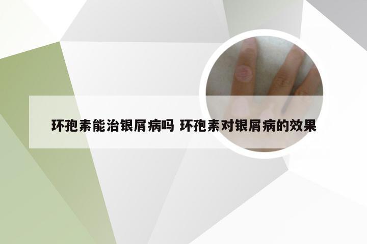 环孢素能治银屑病吗 环孢素对银屑病的效果