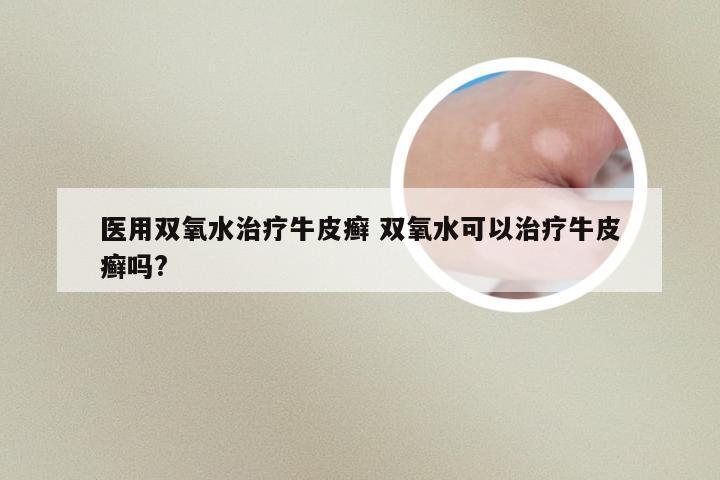 医用双氧水治疗牛皮癣 双氧水可以治疗牛皮癣吗?