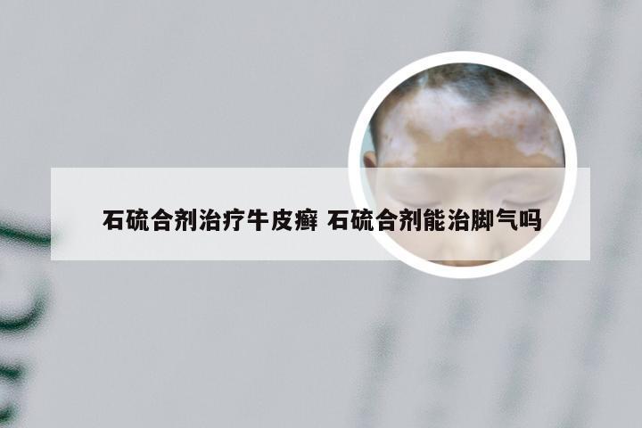 石硫合剂治疗牛皮癣 石硫合剂能治脚气吗