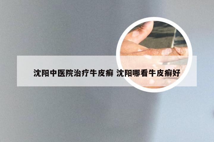 沈阳中医院治疗牛皮癣 沈阳哪看牛皮癣好