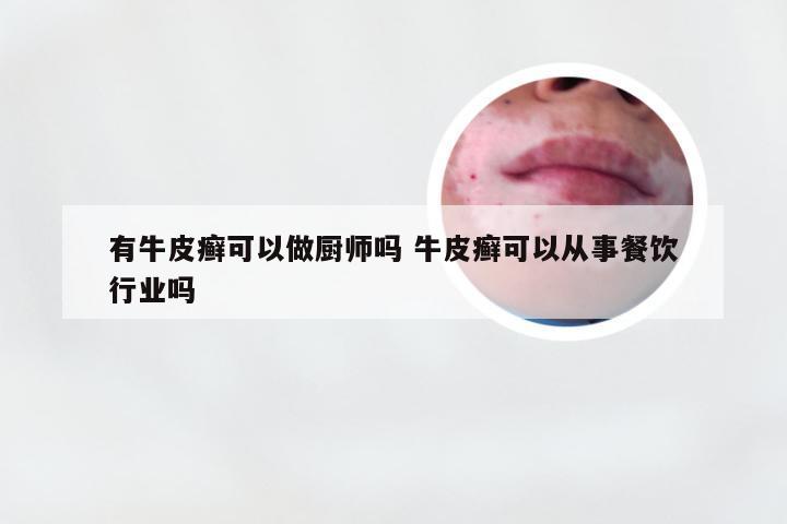 有牛皮癣可以做厨师吗 牛皮癣可以从事餐饮行业吗