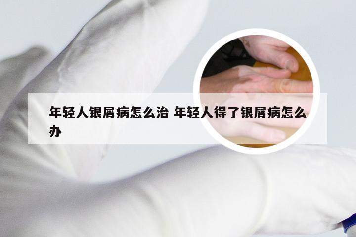 年轻人银屑病怎么治 年轻人得了银屑病怎么办