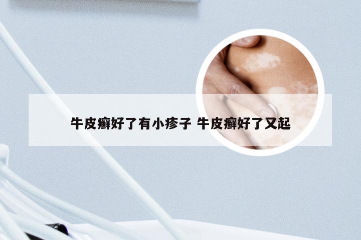 牛皮癣好了有小疹子 牛皮癣好了又起