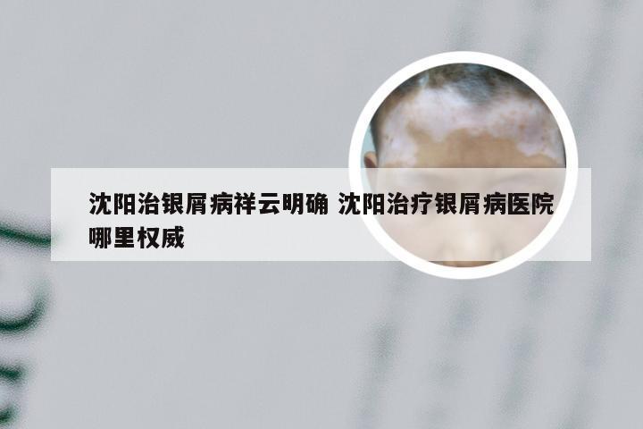 沈阳治银屑病祥云明确 沈阳治疗银屑病医院哪里权威