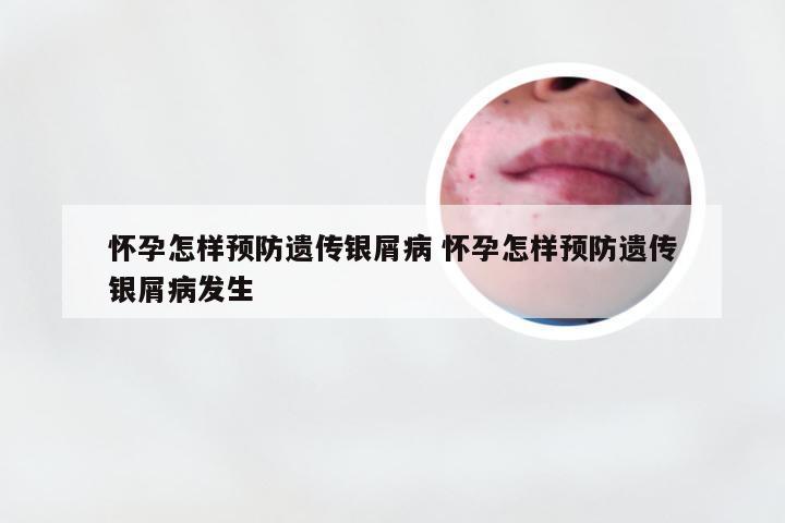 怀孕怎样预防遗传银屑病 怀孕怎样预防遗传银屑病发生