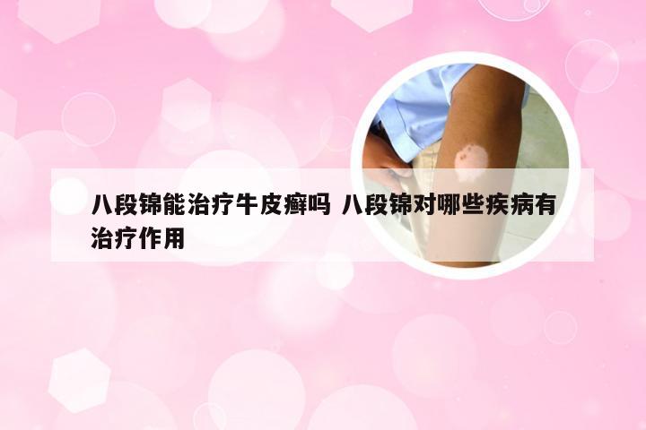 八段锦能治疗牛皮癣吗 八段锦对哪些疾病有治疗作用