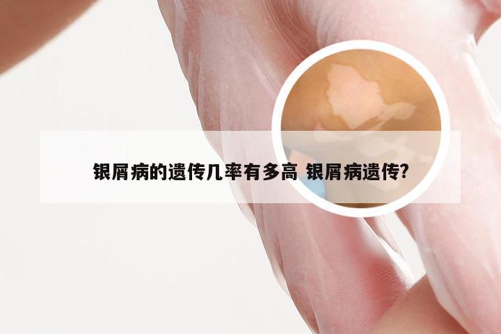 银屑病的遗传几率有多高 银屑病遗传?