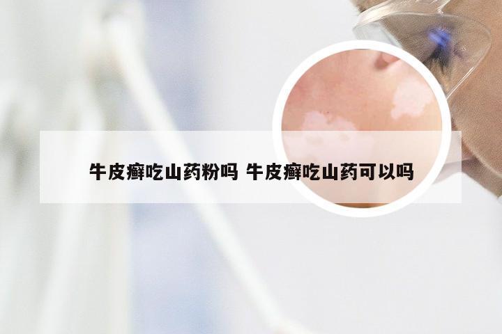 牛皮癣吃山药粉吗 牛皮癣吃山药可以吗