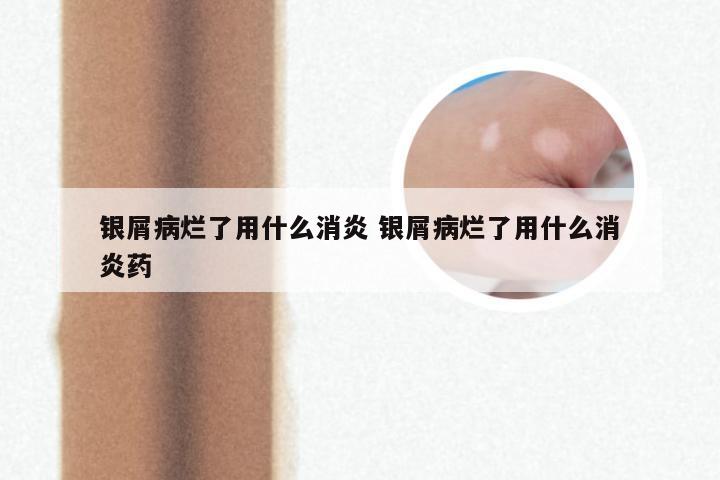 银屑病烂了用什么消炎 银屑病烂了用什么消炎药