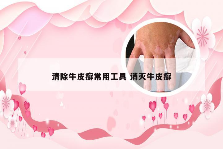 清除牛皮癣常用工具 消灭牛皮癣