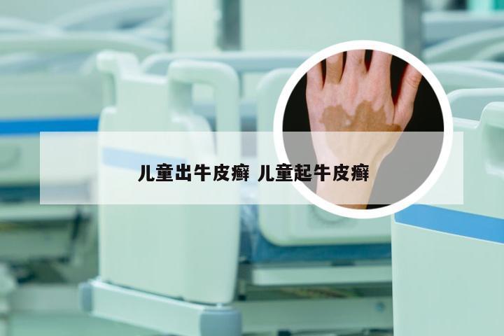儿童出牛皮癣 儿童起牛皮癣