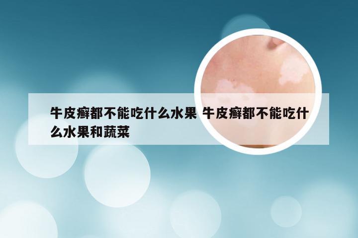 牛皮癣都不能吃什么水果 牛皮癣都不能吃什么水果和蔬菜