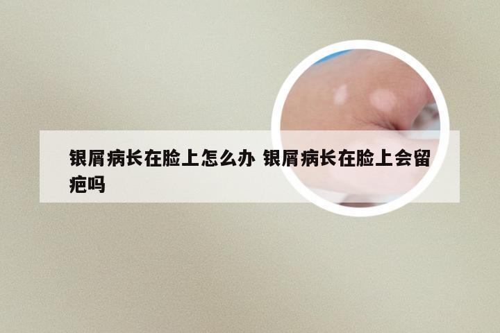 银屑病长在脸上怎么办 银屑病长在脸上会留疤吗