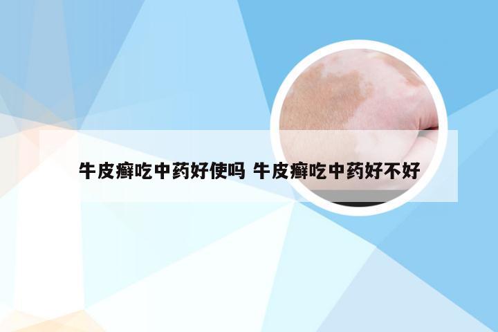 牛皮癣吃中药好使吗 牛皮癣吃中药好不好