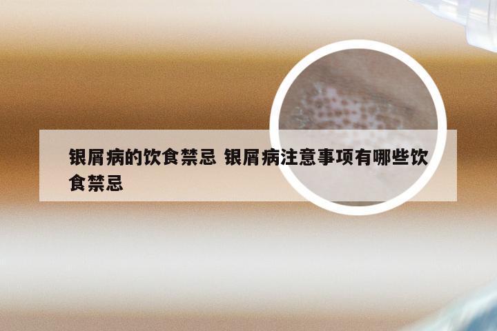 银屑病的饮食禁忌 银屑病注意事项有哪些饮食禁忌