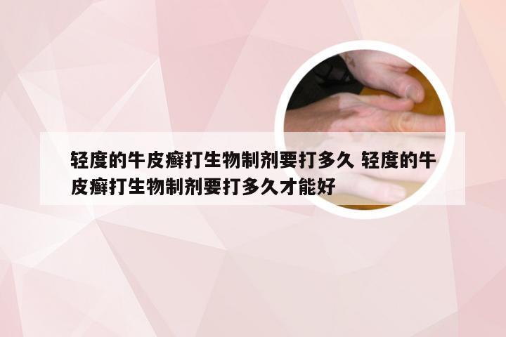 轻度的牛皮癣打生物制剂要打多久 轻度的牛皮癣打生物制剂要打多久才能好