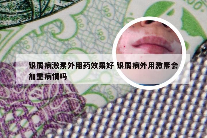 银屑病激素外用药效果好 银屑病外用激素会加重病情吗