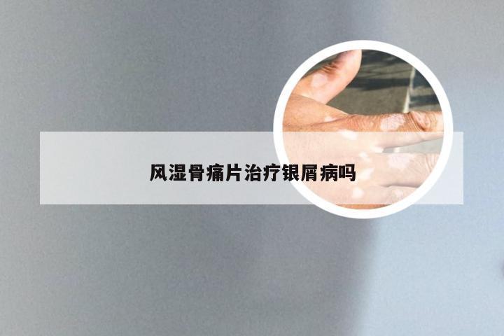 风湿骨痛片治疗银屑病吗