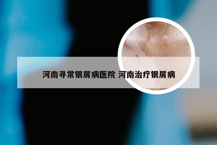 河南寻常银屑病医院 河南治疗银屑病