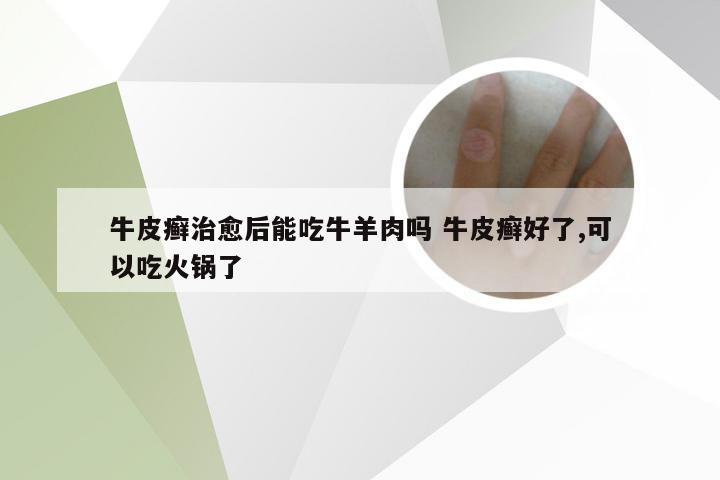 牛皮癣治愈后能吃牛羊肉吗 牛皮癣好了,可以吃火锅了