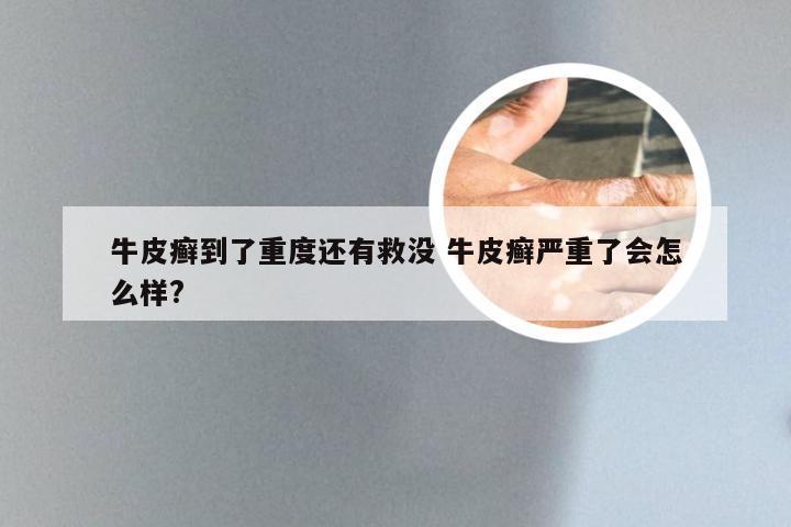 牛皮癣到了重度还有救没 牛皮癣严重了会怎么样?
