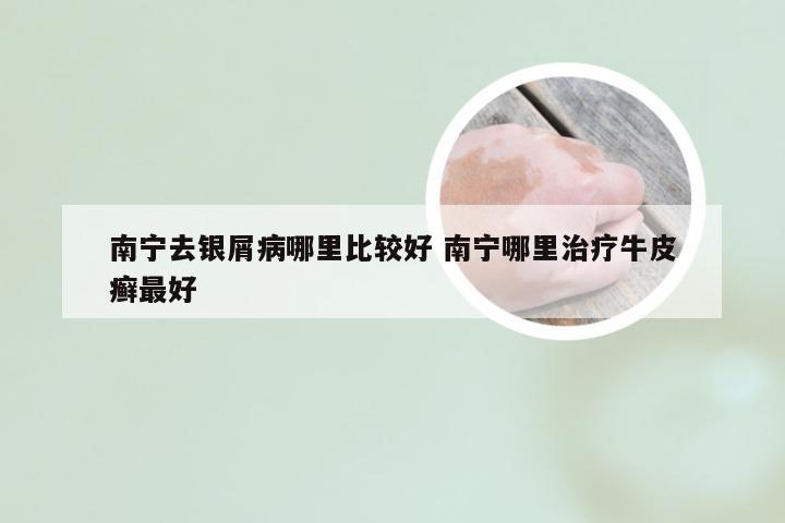 南宁去银屑病哪里比较好 南宁哪里治疗牛皮癣最好