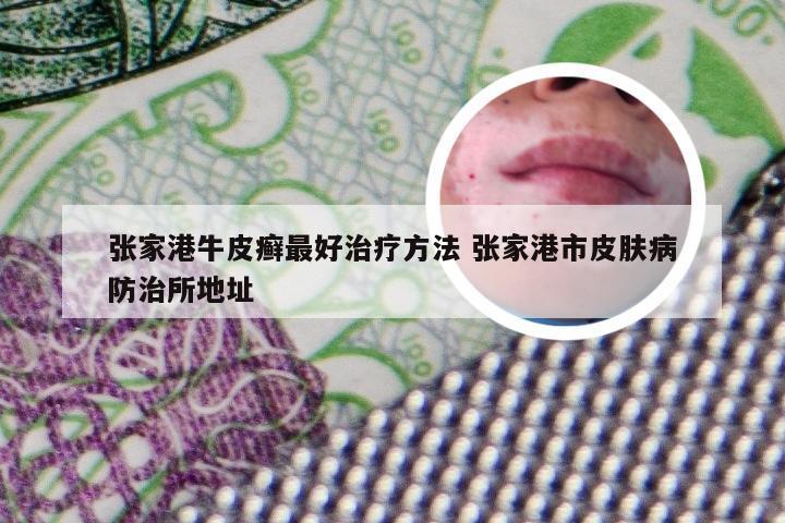张家港牛皮癣最好治疗方法 张家港市皮肤病防治所地址
