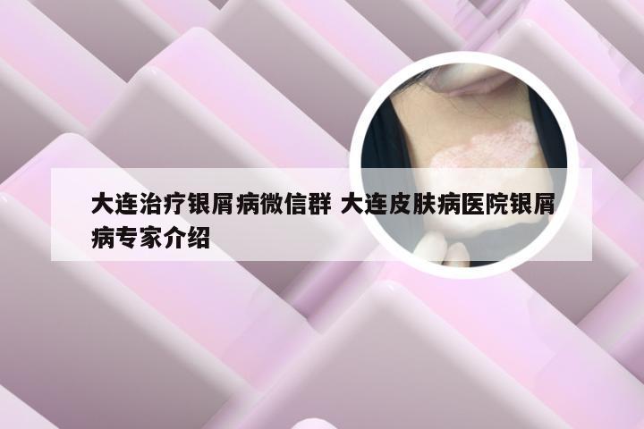 大连治疗银屑病微信群 大连皮肤病医院银屑病专家介绍