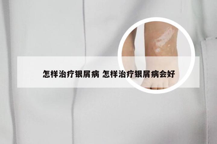 怎样治疗银屑病 怎样治疗银屑病会好