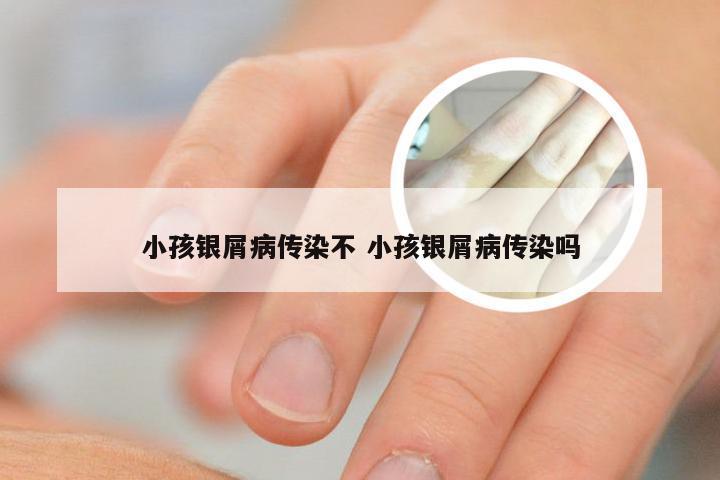 小孩银屑病传染不 小孩银屑病传染吗